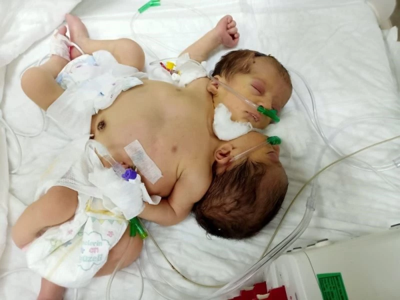 Afrinli yapışık ikizler Hatay’a getirildi
