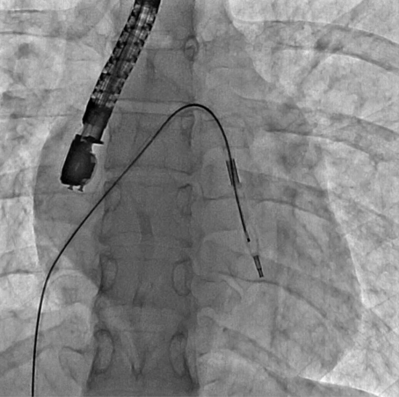 Mitral balon operasyonu adım adım kaydedildi
