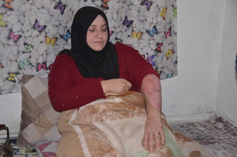 Suriyeli savaş mağduru kadın vücudundaki yanıklarla hayata tutunmaya çalışıyor