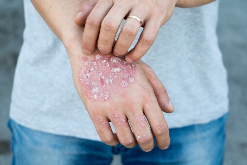 “Soğuk hava psoriasis’i şiddetlendiriyor”
