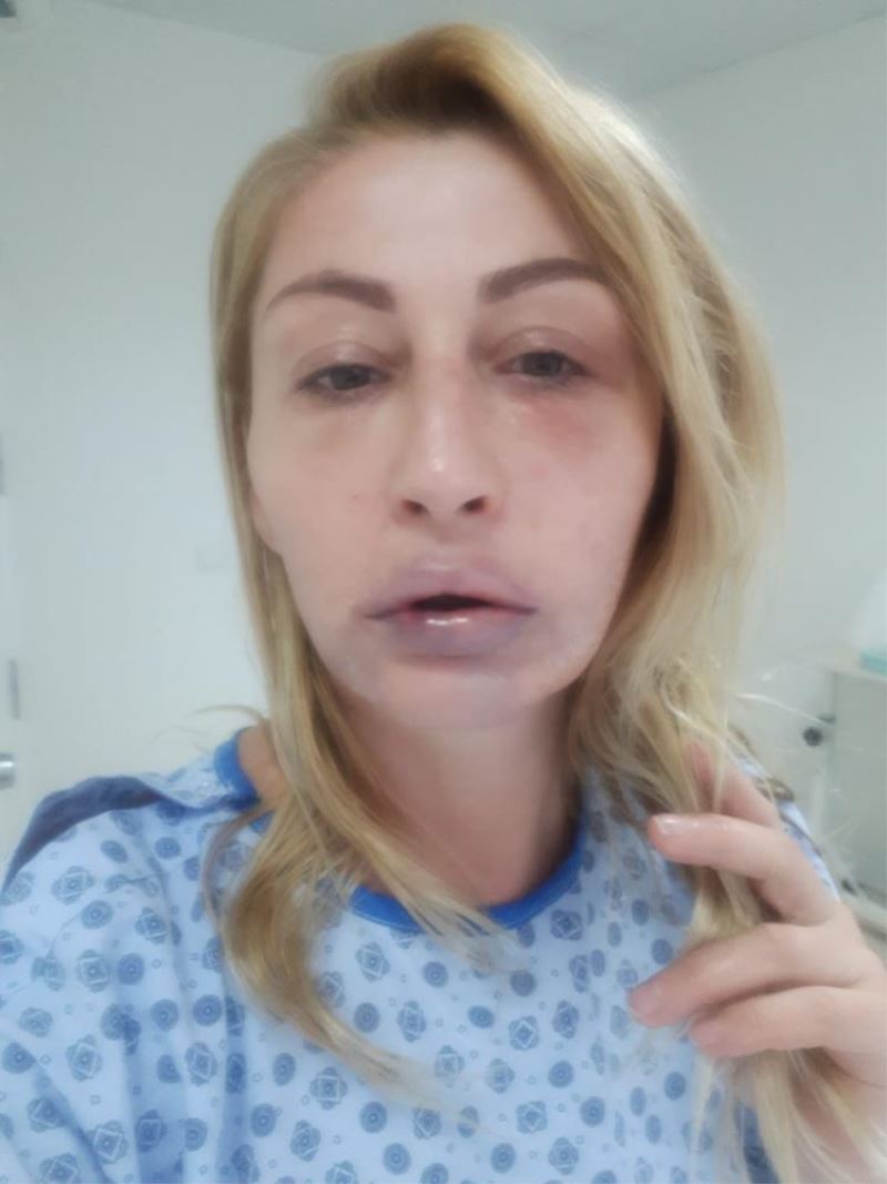 Geçirdiği operasyonda dudağının zarar gördüğünü iddia eden kadının 