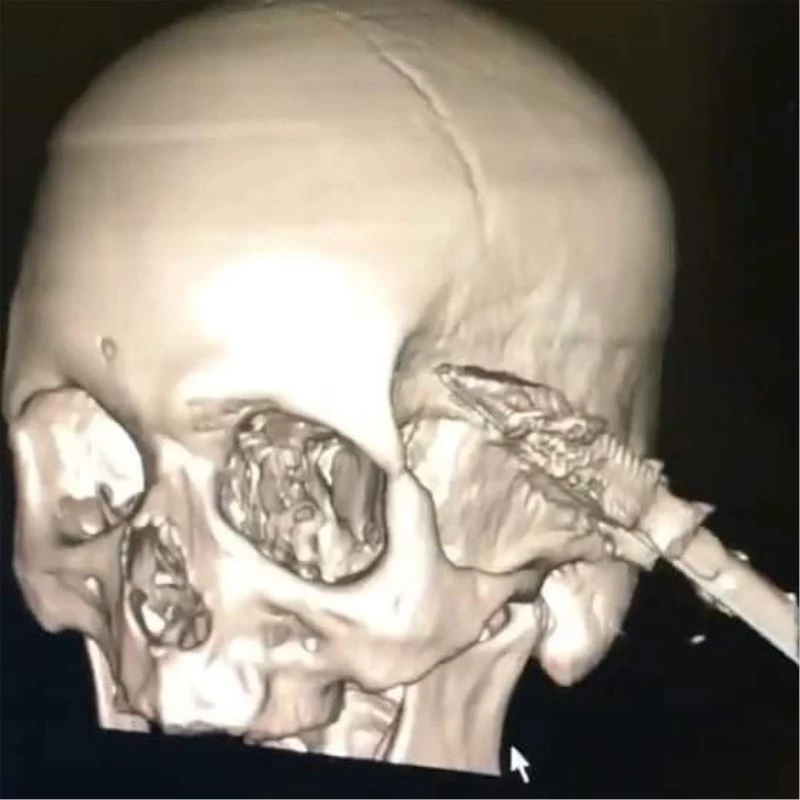 Uyuduğu sırada koltuktan düşen şahsın başına soba maşası saplandı
