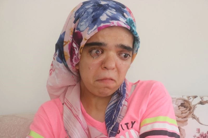 21 yaşındaki genç kız, güzelliğine kavuşmak için yardım bekliyor
