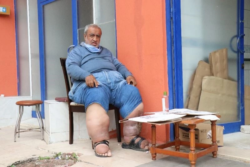 Fil hastalığının tedavisi için yetkililerden yardım istiyor
