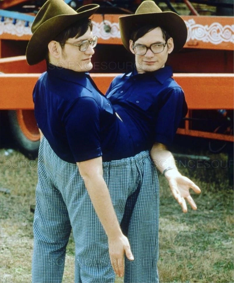 Dünyanın en uzun hayatta kalan yapışık ikizleri 68 yaşında öldü
