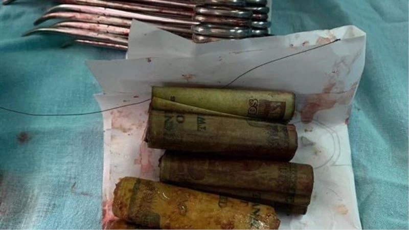 Mısır’da bir kişinin midesinden 6 bin 500 Mısır lirası çıktı
