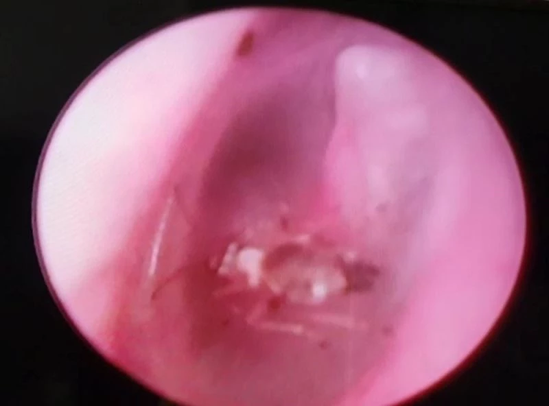 Kulağından canlı sinek çıktı
