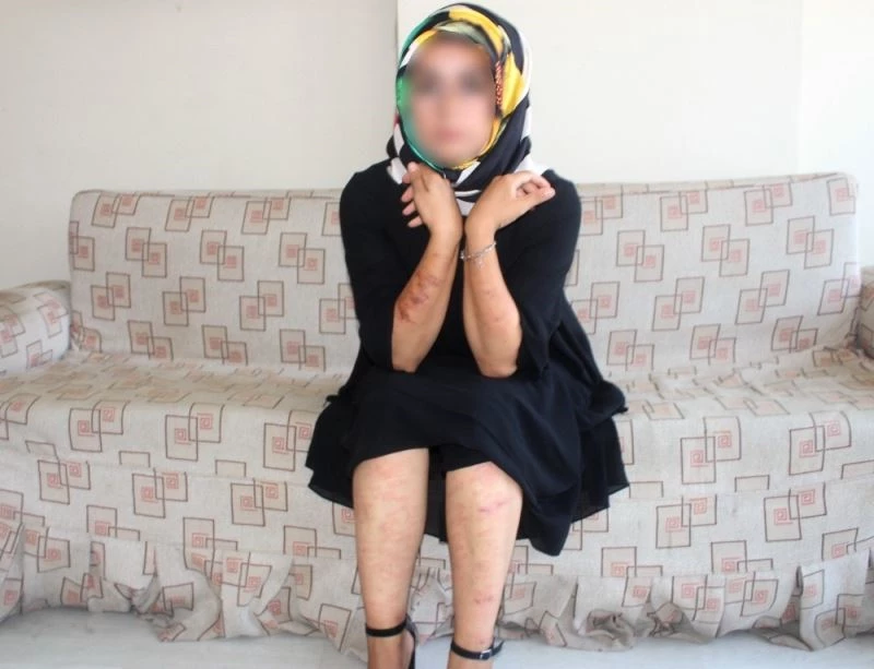 Lazer genç kadının vücudunu yaktı
