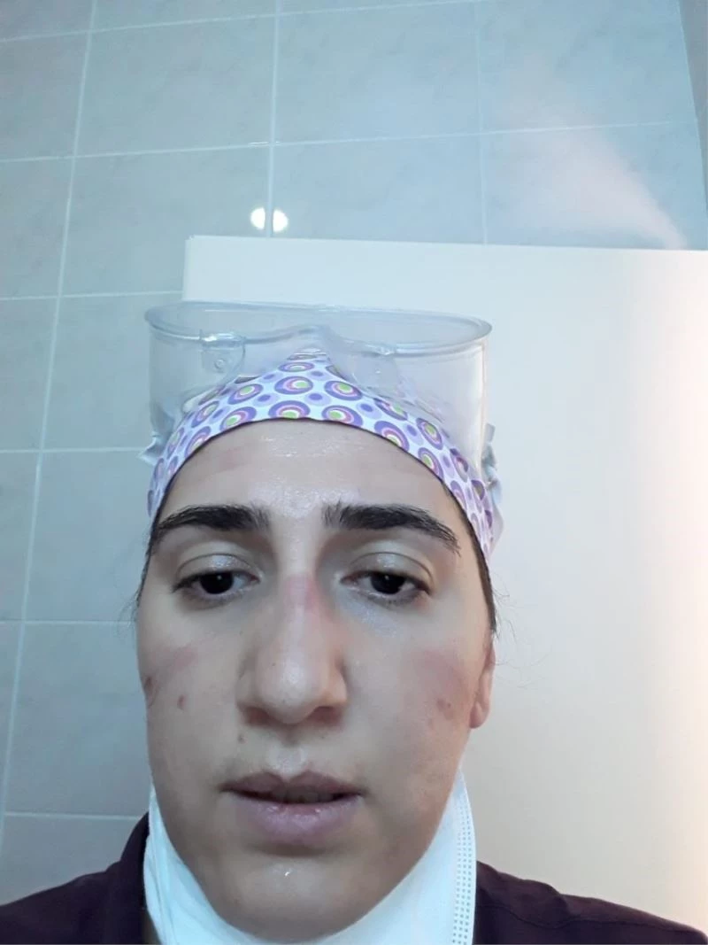 24 saat maske ve gözlükle hastalara baktı, yüzünde yaralar oluştu
