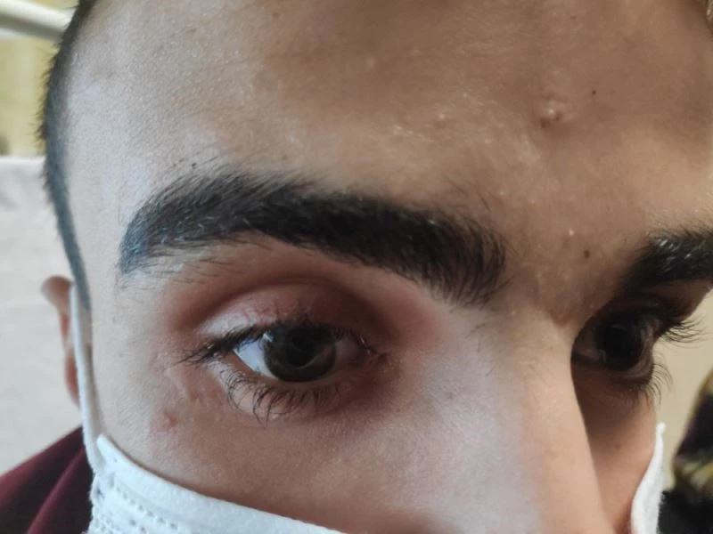 Gözünde unutulan cam kırığı ile bir ay yaşadı
