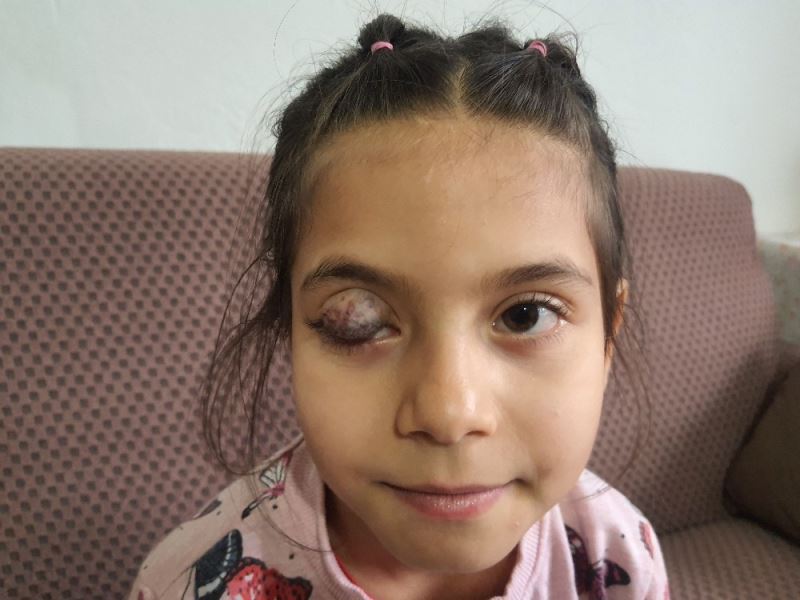 Göz kapağında doğuştan tümör bulunan 7 yaşındaki Beyza’nın yardım çığlığı
