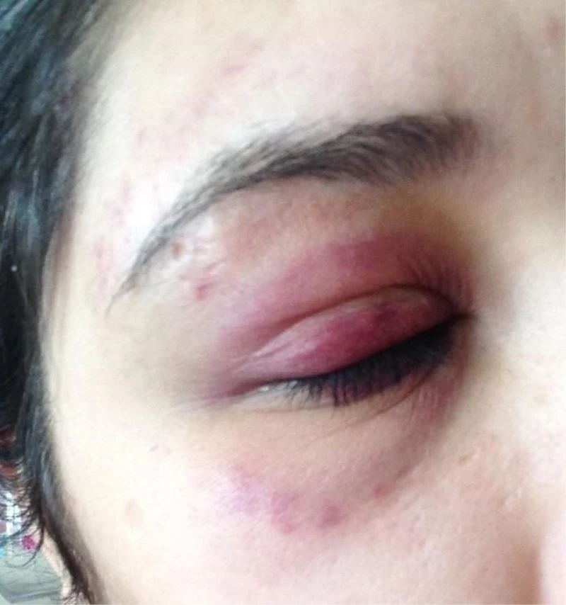 Genç kızı darp eden avukat: “Alkolü döktüm diye şişe fırlatıp tokat attı”
