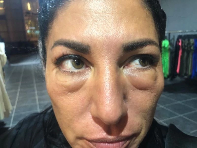 (Özel) Gözaltı ışık dolgusu yaptırdı, hayatı karardı
