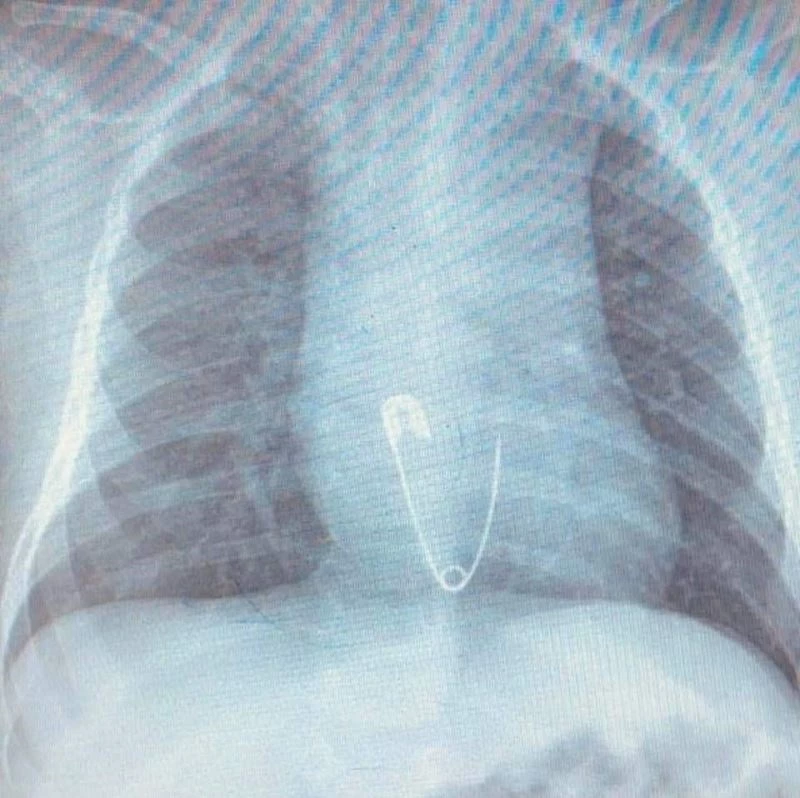 5 aylık bebeğin yuttuğu çengelli iğne operasyonla çıkarıldı
