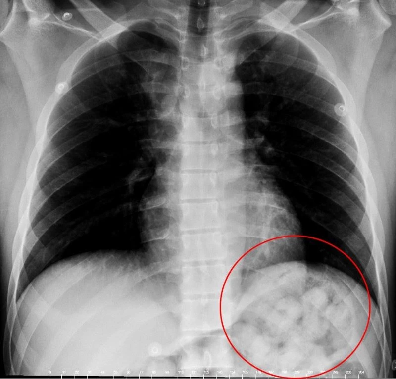 Karnından uyuşturucu zulası çıktı
