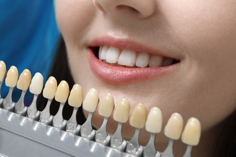Dişleri beyazlatmada sosyal medya önerileri sağlığınıza zarar verebilir
