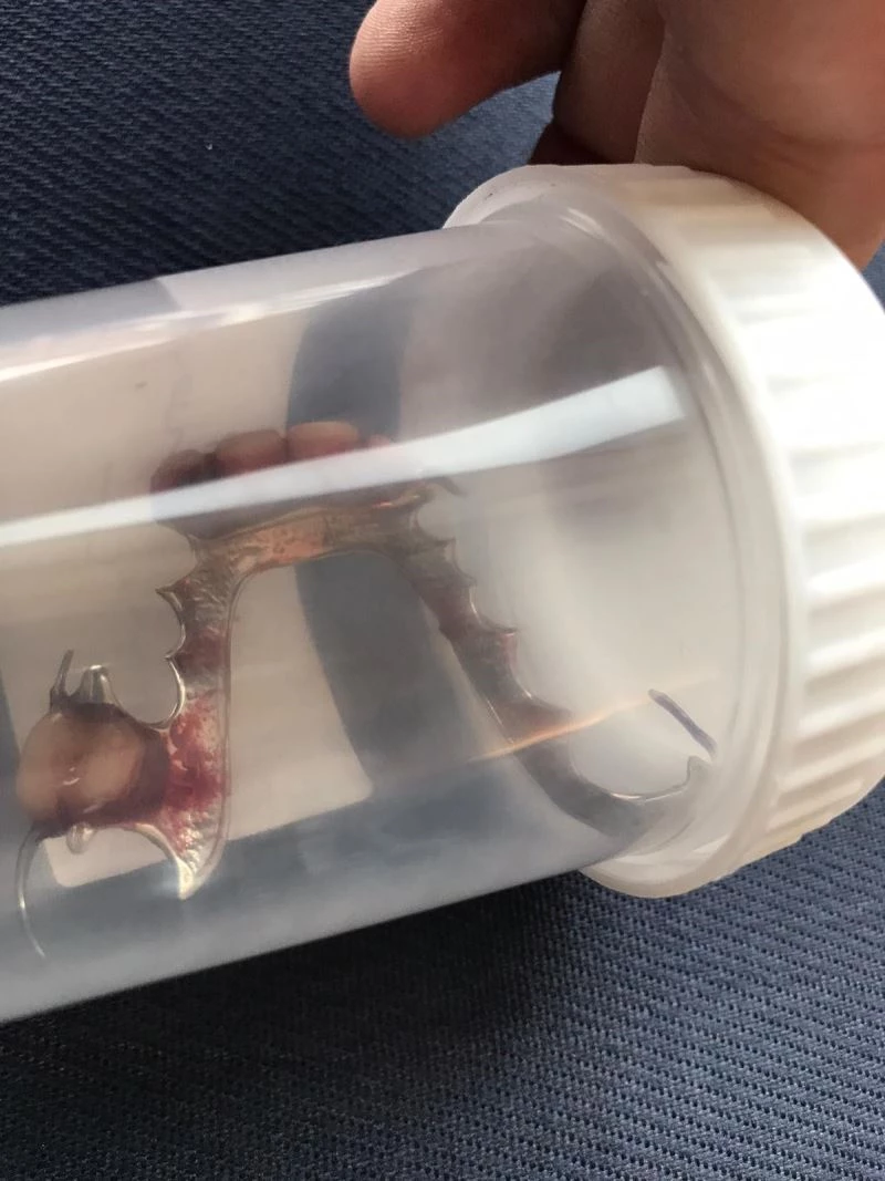 Boğazı acıyan ve nefes almakta zorluk çeken kadının boğazından bakın ne çıktı?
