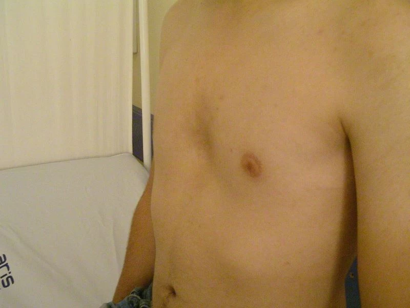 Göğüs kafesindeki çukurluk, solunumu ve kalbi zor durumda bırakabilir
