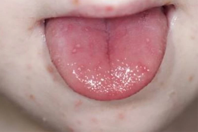 Sıcaklığın artmasıyla birlikte bu hastalıkta da artış yaşanıyor