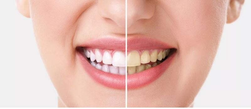 Bilinçsiz yapılan dişlerde ağartma işlemi kalıcı hasarlara neden oluyor
