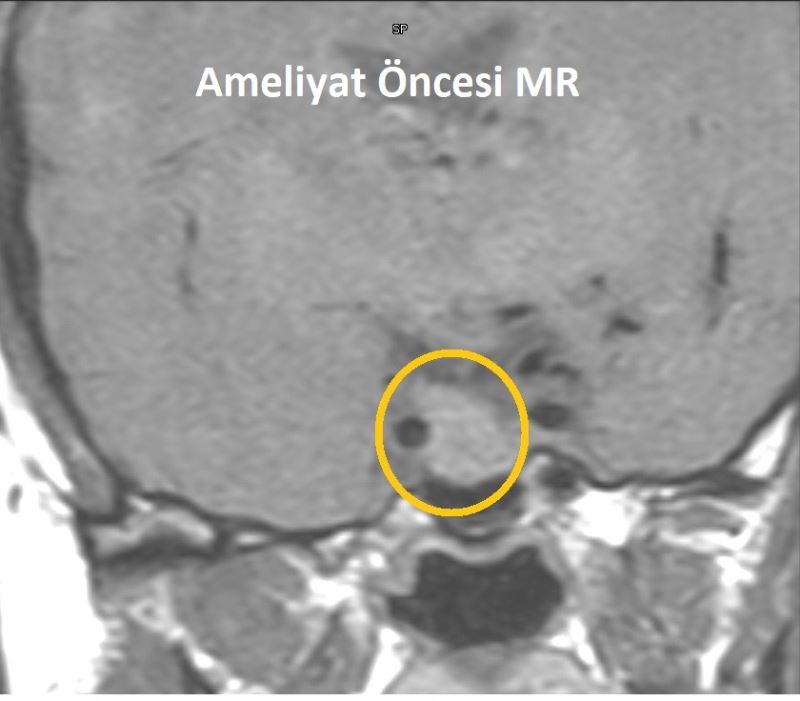 Hipofiz tümörü olan kadın başarılı bir ameliyatla tedavi edildi
