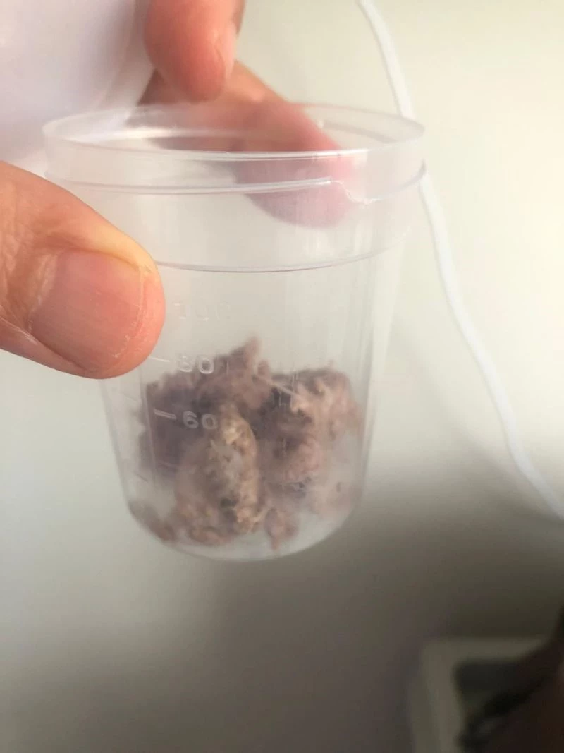 Yemek borusundan 6 santimlik et parçası çıktı
