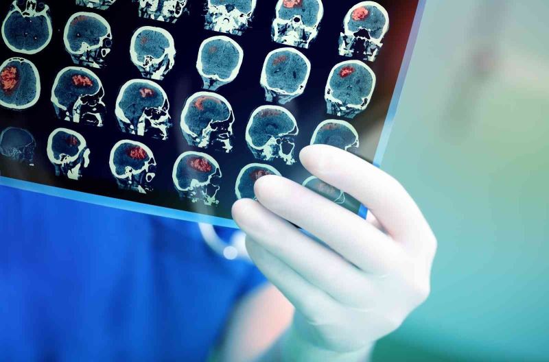 Yeni cerrahi teknolojiler beyin tümörü ameliyatlarındaki başarıyı artırıyor
