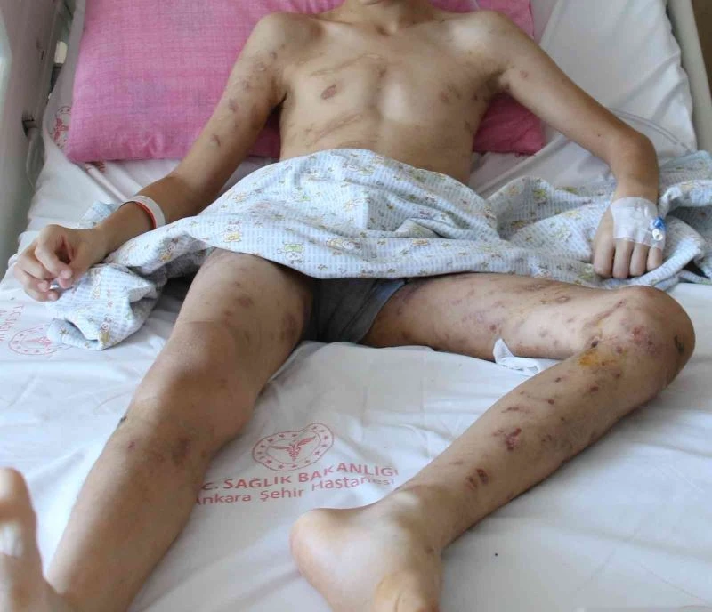  10 köpeğin saldırısına uğrayan 12 yaşındaki Enes, 9 cerrahi operasyon geçirdi, 6-7 tane daha geçirmesi planlanıyor
