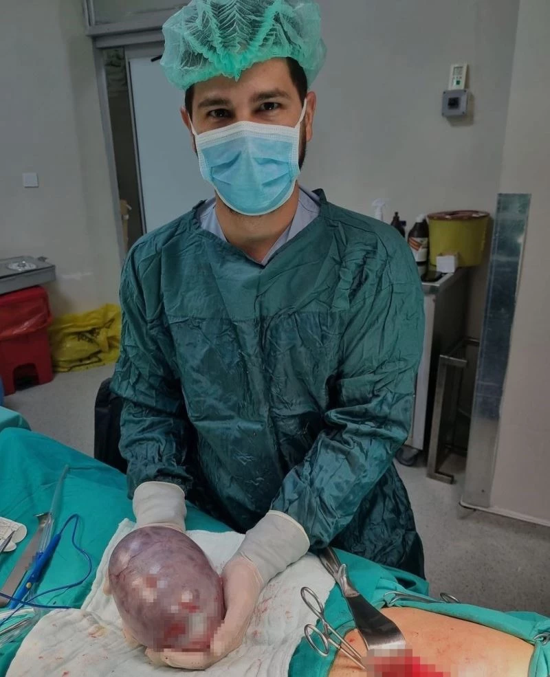 Yumurtalık kanserine yakalanan hastadan 17 santimetrelik tümör çıkarıldı
