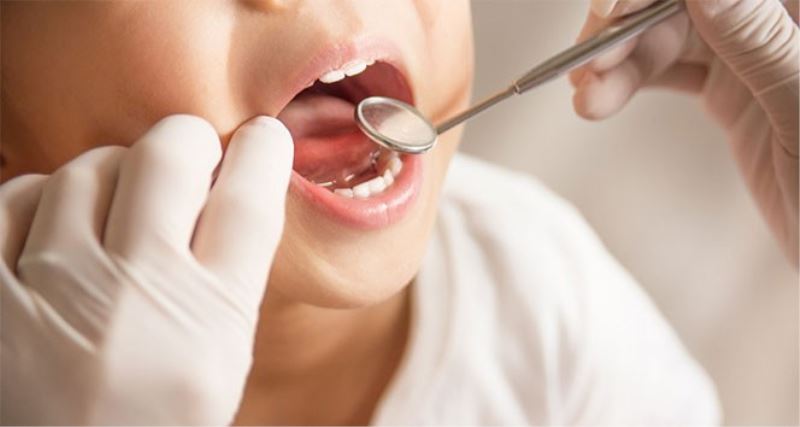 Flor diş çürüklerini yüzde 20 ile 40 arasında engelliyor
