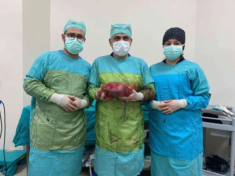 Karnında şişlik olan hastanın büyüyerek 25 santim olan böbreği alındı
