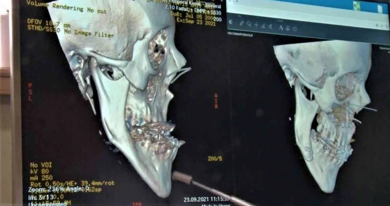 Doğuştan çene bozukluğu olan hastaya estetik çene: 21 yıl sonra çenesi düzeldi
