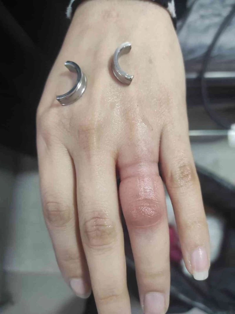 Parmağa sıkışan yüzüğü itfaiye ekipleri çıkardı
