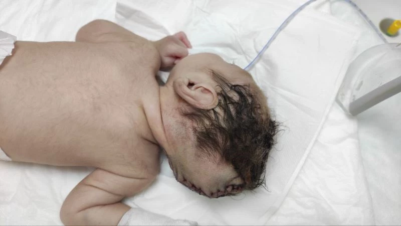 Beyninin yarısı kafatası dışında dünyaya geldi
